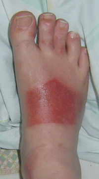 my sunburned foot!